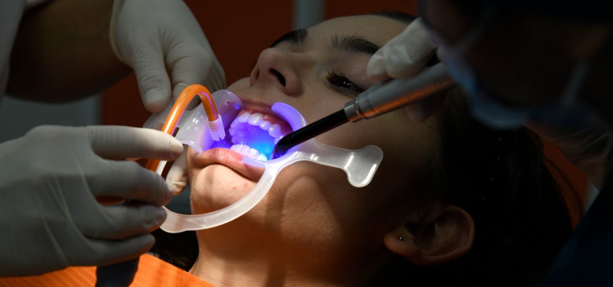 Sigillature dentali: cosa sono e a cosa servono?