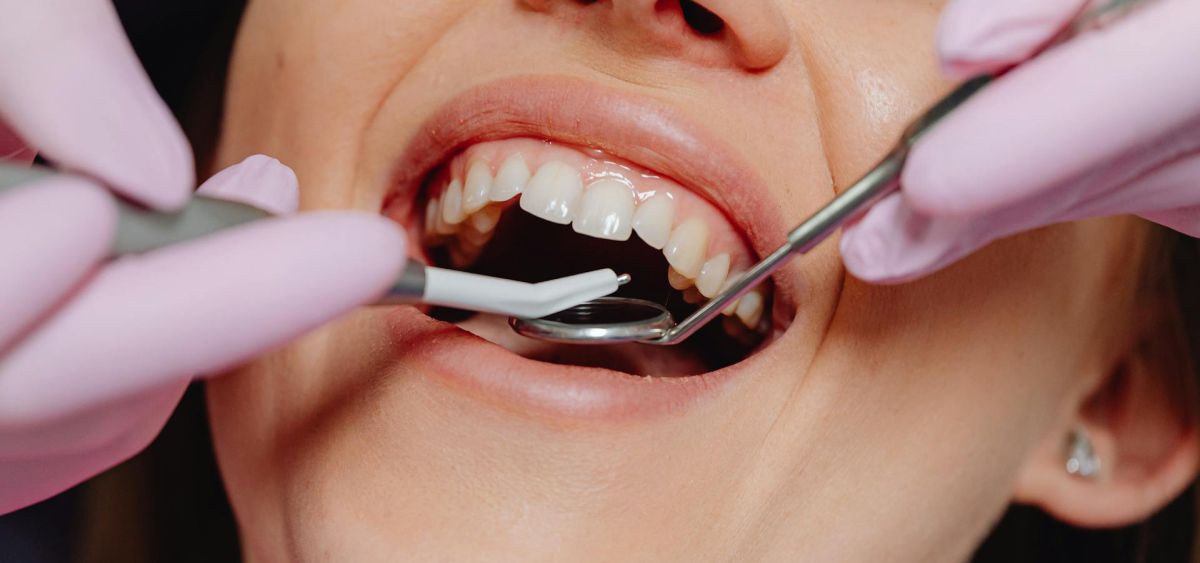 Sbiancamento dentale: cos'è e come funziona